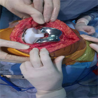 Knee Replacement Surgery in Nashik
