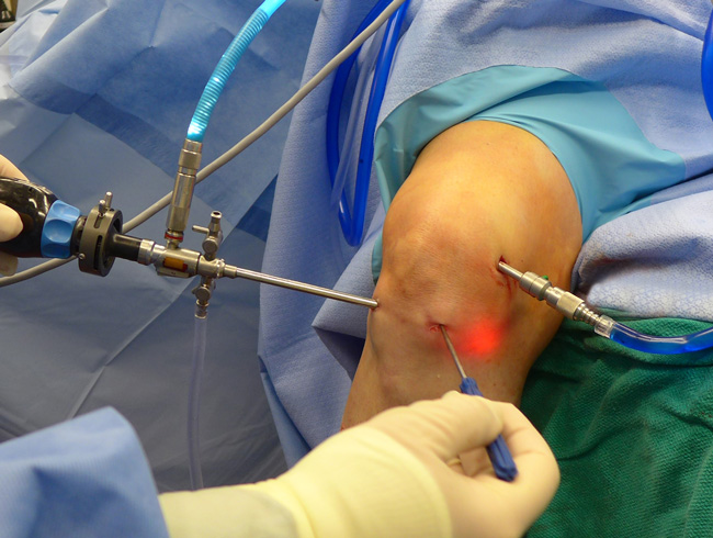 meniscus surgery